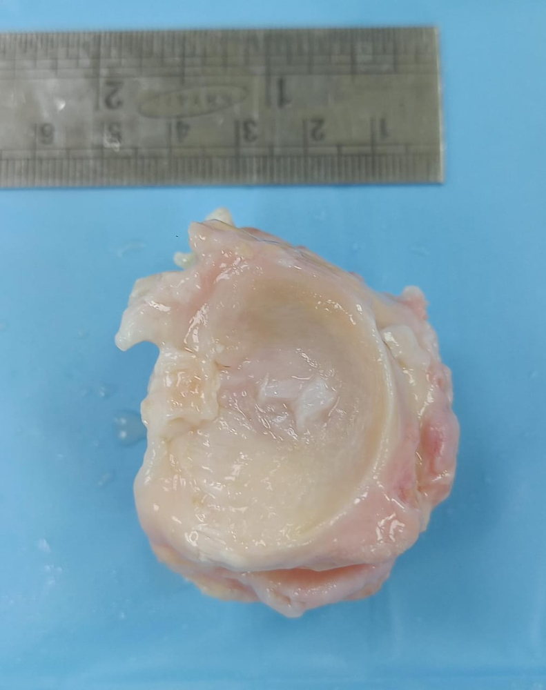 Lt.Lat.Meniscus with bone plug - MB013
