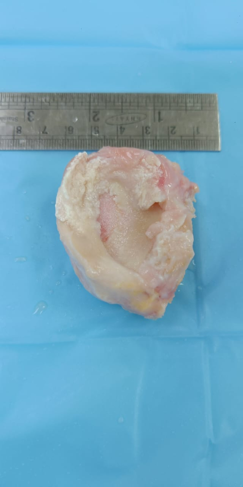 Lt.Med.Meniscus with bone plug - MB014