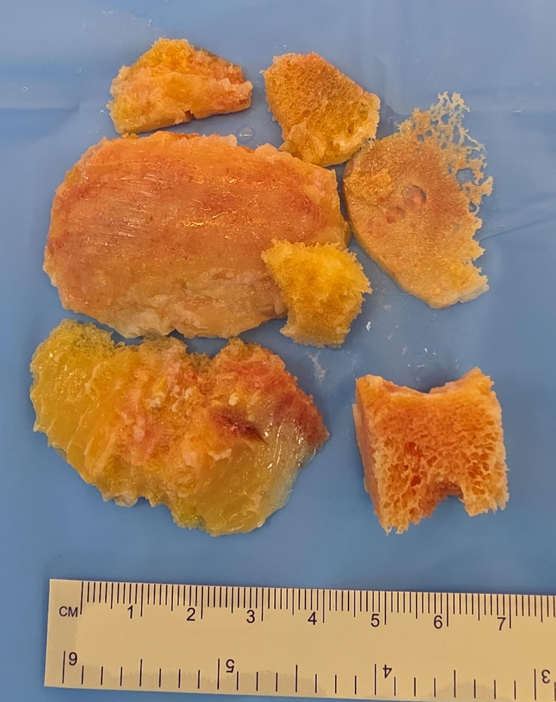 TKR Slices - TS1022
